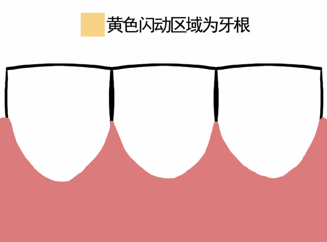 牙龈萎缩gif.gif